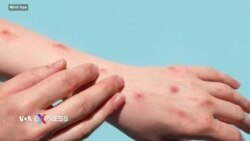 Việt Nam ghi nhận ca tử vong đầu tiên vì đậu mùa khỉ  Việt Nam ghi nhận ca tử vong đầu tiên vì đậu mùa khỉ