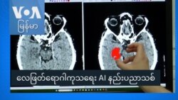 လေဖြတ်ရောဂါကုသရေး AI နည်းပညာသစ် လေဖြတ်ရောဂါကုသရေး AI နည်းပညာသစ်