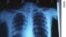 အဆုပ်ရောဂါ (Tuberculosis) ကုထုံးသစ် နဲ့ ကာကွယ်ရေး